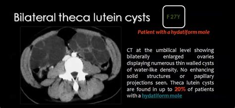 Theca Luteum Cyst