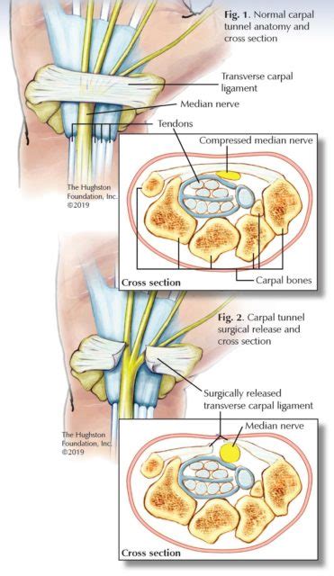 A splint can help ease the pain of carpal tunnel syndrome, especially at night. Carpal Tunnel Syndrome | Hughston Clinic