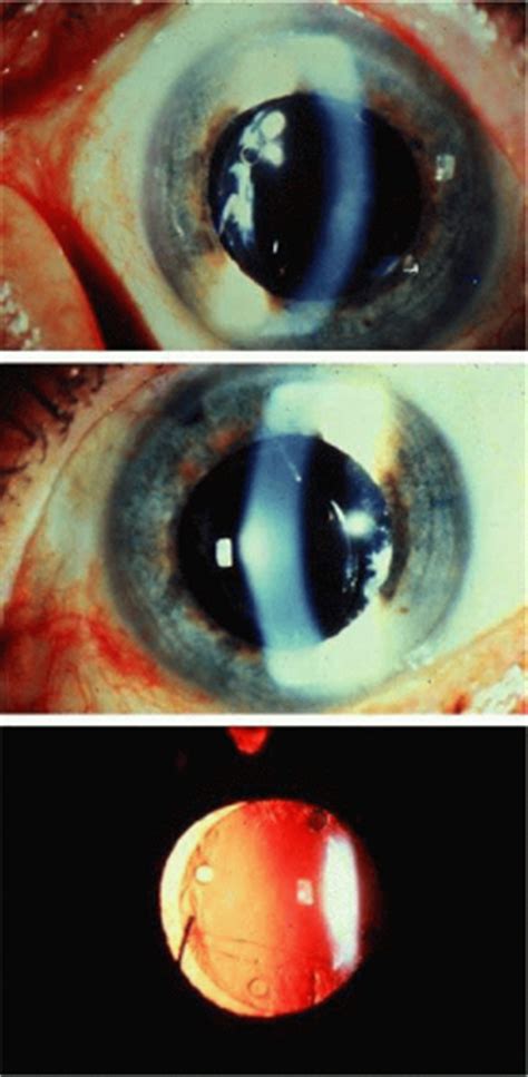 The word pseudophakia refers to the situation in which the natural lens of an eye has been replaced with a plastic implant lens located at approximately the position previously occupied by the natural lens. Glaucoma in Aphakia and Pseudophakia | Ento Key