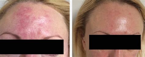 Dermalux Flex Led Treatment And Reviews London Premier Laser Clinic