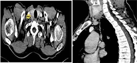 A And B Cervical Computed Tomography Scan Showing A Hypodense