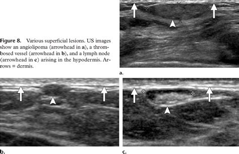 Figure 8 From Distinguishing Breast Skin Lesions From Superficial