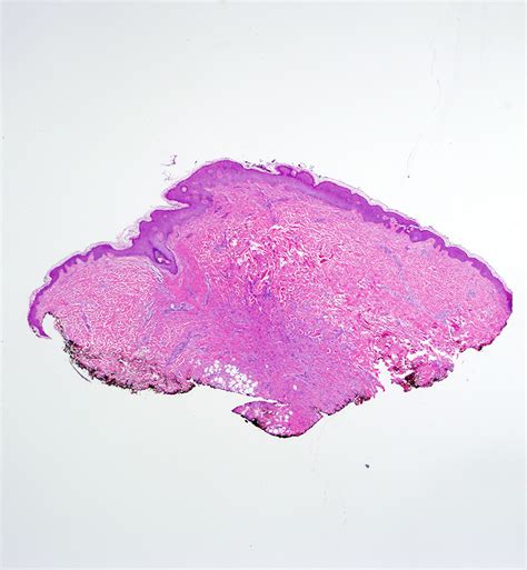 Dermatofibroma Histology