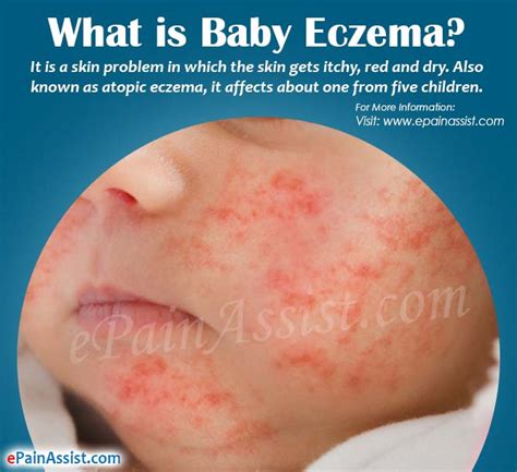 Eczema On Baby Hands