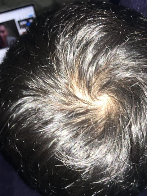 Is This A Bald Spot Or A Cowlick Im 16 M Rhairloss
