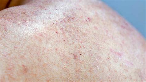 A Deeper Look At Atopic Dermatitis In Adults Case Study Mycme