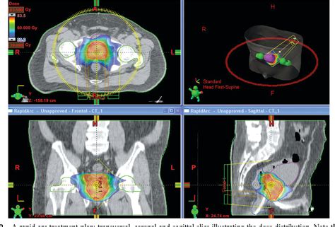 External Beam Radiotherapy For Prostate Cancer Semantic Scholar