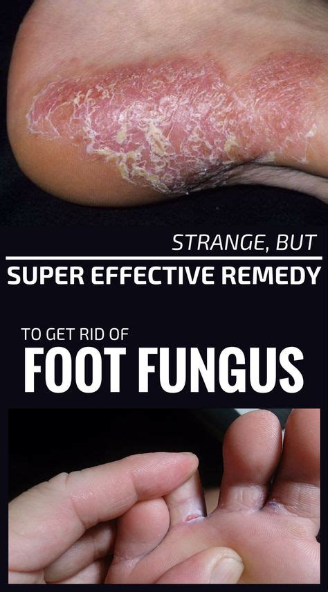 Strange But Super Effective Remedy To Get Rid Of Foot Fungus Foot