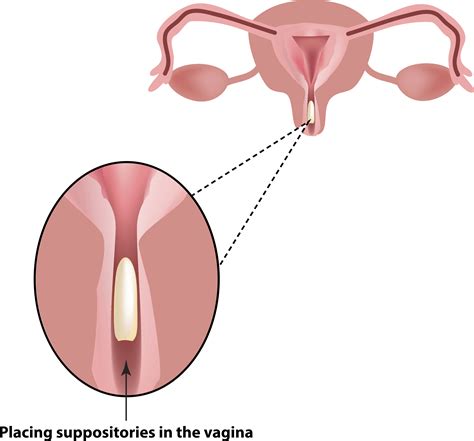 Vaginal Suppositories How To Open Insert Coast To Coast Compounding Suppositories Why