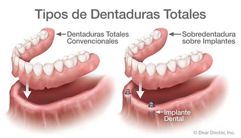 Dentaduras Removibles General And Cosmetic Dentist