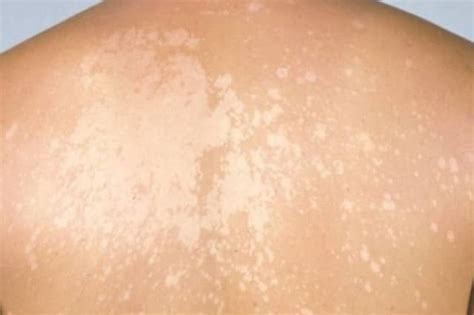 White Spots On Skin Patches Pictures Small Sun Fungus Causes