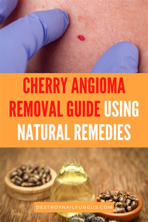 Cherry Angioma Removal Apple Cider Vinegar And Other Home Remedies