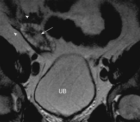 Dermoids, a term now used almost always interchangeably with teratomas, are tumors derived from more than one germ layer, frequently all three. Multimodality imaging of ovarian cystic lesions: Review ...
