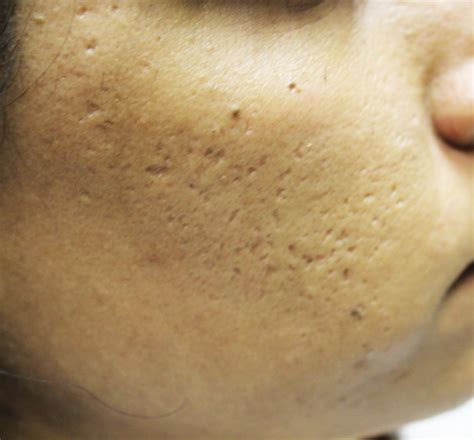 Skinpen Microneedling Treatments In Columbus Dr Nina Deep