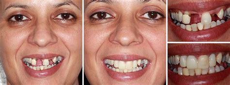 Replace Missing Front Teeth Maidstone Dental