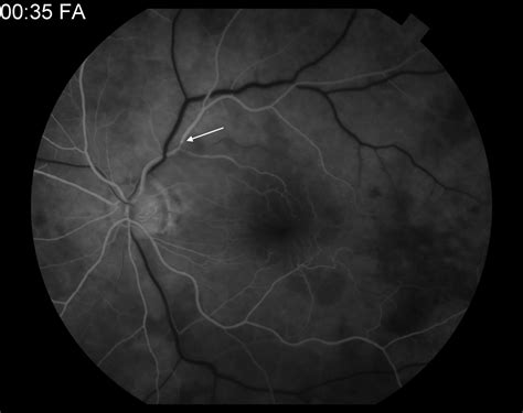 Moran Core Fundus Photography And Fluorescein Angiography Of Branch