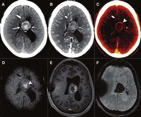 Material Specific Iodine Images In Head De Ct A Non Contrast Enhanced