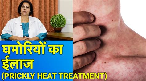 घमोरियों का ईलाज Prickly Heat Treatment In Hindi Youtube