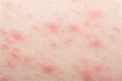 Identifying The Cause Of Contact Dermatitis Dermatitis Topical