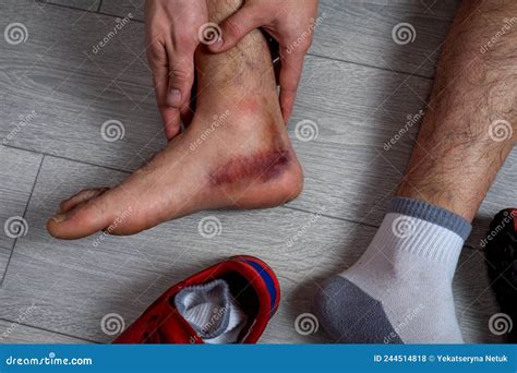 Ankle Injury With Dislocation And Sprains Fracture Or Leg Sprain