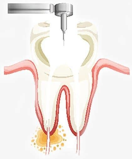 In some cases, existing dental insurance will cover 80% of a root canal procedure's cost. Root Canal Treatment | Endodontic Treatment | DentalSave ...