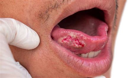 Oral Squamous Cell Carcinoma Mouth Cancer Symptoms And More