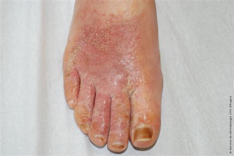 Types Of Eczema On Feet Best Games Walkthrough