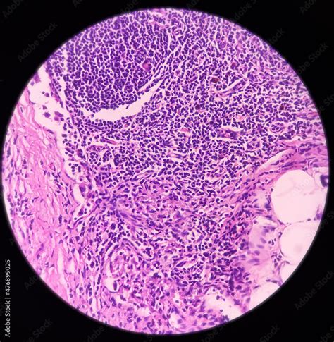 Parotid Tumor Pleomorphic Adenoma Benign Neoplasm Composed Of