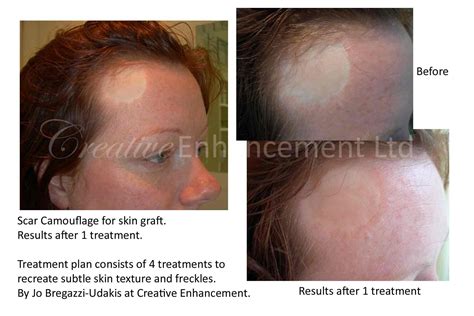 In several interviews last year, williams said that he no longer wanted while the original procedure was to be done through taking skin grafts and placing them over the existing tattoos williams opted for the laser treatment instead. Scar Camouflage Discount Package (Year Long) - Jo Bregazzi