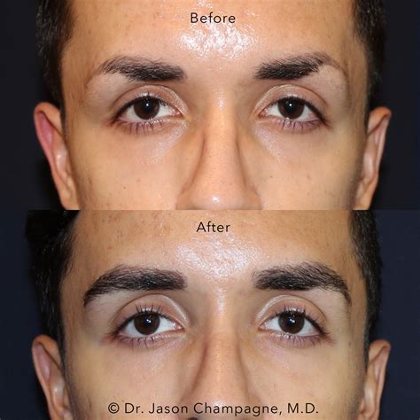Male Eyebrow Hair Transplant — Plastic Surgeon Beverly Hills Ca Dr Jason Champagne