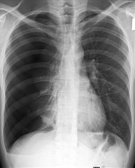 Tension Pneumothorax Chest X Ray Download Scientific Diagram