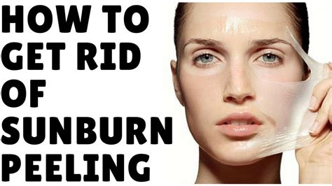 How To Get Rid Of Sunburn Peeling Youtube