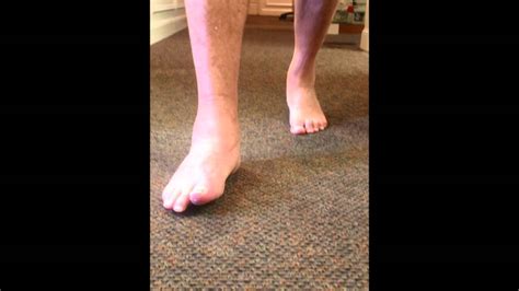 Gait After Triple Arthrodesis Surgery For Pttd Sfism Youtube