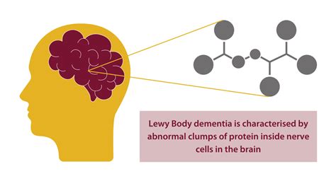 Lewy Body Dementia Rice