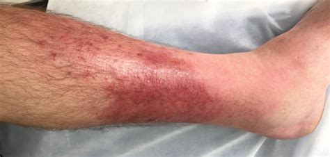 Is Cellulitis Contagious Heres What You Need To Know