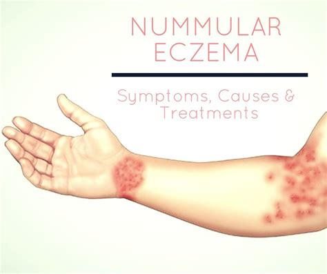 Nummular Dermatitis Eczema Diagnosis And Treatments Nummular Eczema