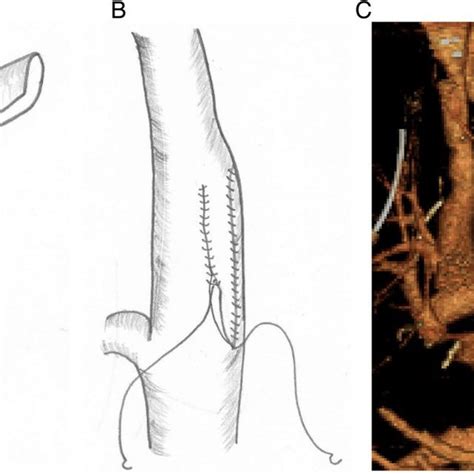 Reconstruction Of The Svc With The Left Brachiocephalic Vein A After
