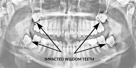 Wisdom Teeth Oral Surgery Procedures