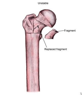 In all intertrochanteric fractures, if the fracture line extends distally, a long nail will be necessary. Intertrochanteric Hip Fractures: Practice Essentials ...