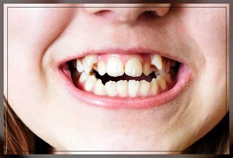 Snaggle Tooth How To Fix It Dentist Ahmed Official Website