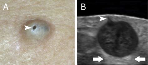 Epidermoid Cyst In An Year Old Boy A Transverse Sonography Shows