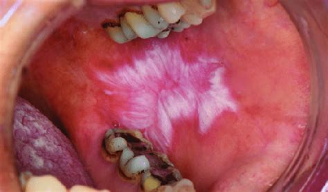 Oral Lichen Planus In The Left Buccal Mucosa With A Central Ulceration