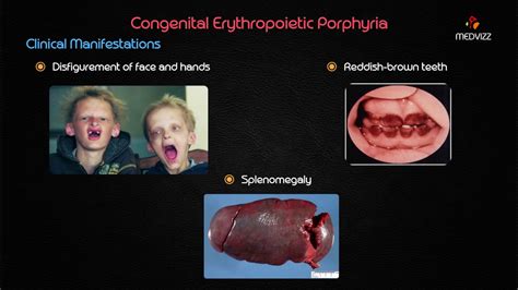 Porphyria Teeth