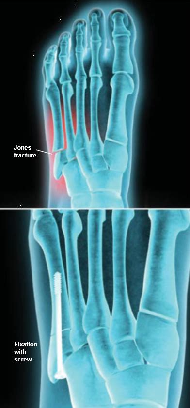 Discovery how to recovery quick & start walking again. Jones Fracture Fixation | Central Coast Orthopedic Medical ...