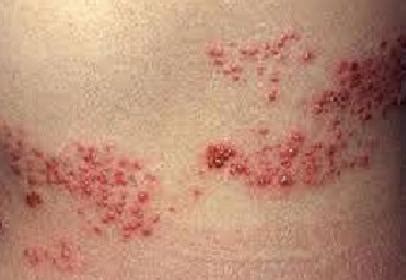 Chicken pox juga dikenali sebagai cacar air, jintungan atau bertih (mengikut kerosakan otak akibat radangan otak. "Punca-Punca Penyakit Kayap-10 Tanda Awal Penyakit Kayap ...