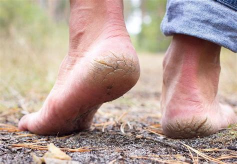 Podiatrist Discusses Causes Of Dry Feet