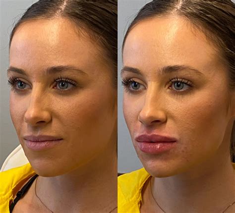 Botox Before And After Lips K Off