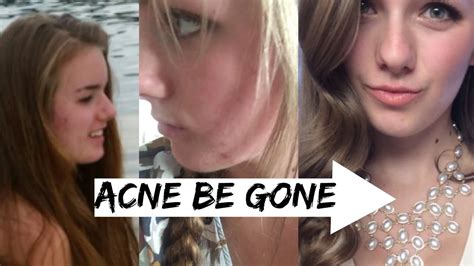 How I Got Clear Skin My Acne Story Accutane Patient Youtube