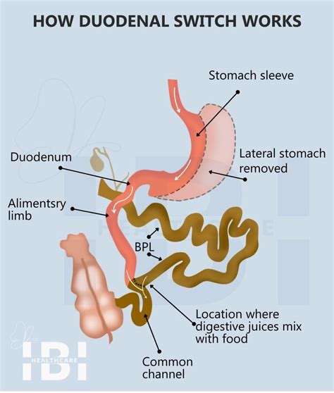 Duodenal Switch Surgery Bpd Ds Weight Loss For Bmi 40