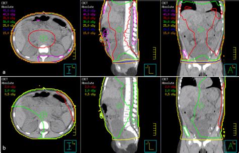 Cone Beam Ct Radiation Therapy The Best Picture Of Beam